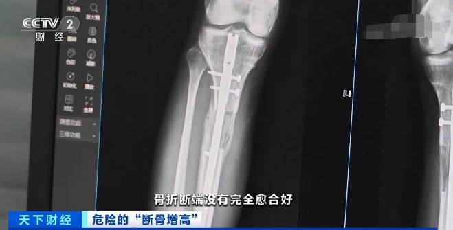 拜仁官宣穆西亚拉将接受手术，腓骨骨折严重，恐致长期缺的简单介绍